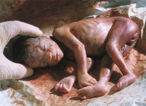 abortedbaby37