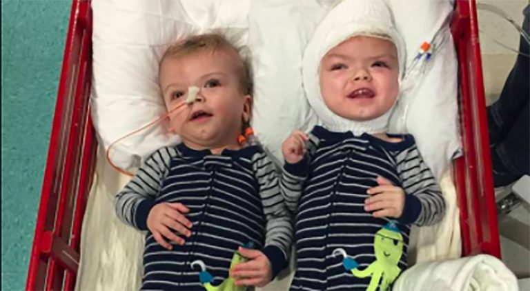 Formerly Conjoined Twins Beating The Odds After Separation Surgery 8089