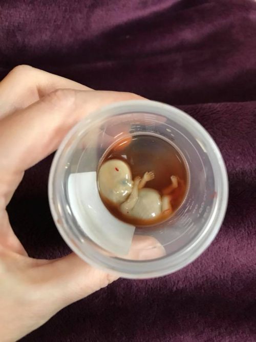 Mother shares incredible photo of baby miscarried at 11 weeks