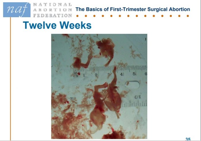Image: NAF Slide products of conception abortion at twelve weeks