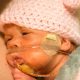 preemie, born alive