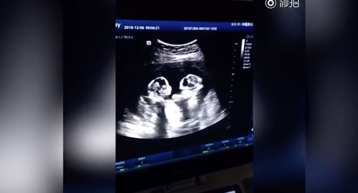 twins ultrasound