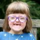 Sarah, craniofacial abnormalities, Apert syndrome