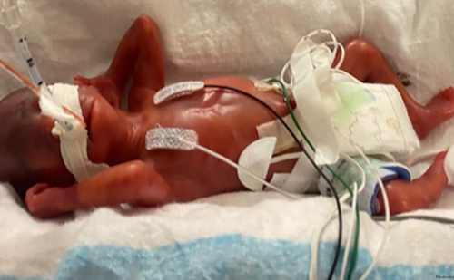 World’s youngest preemie, born just over 21 weeks, celebrates his fourth birthday