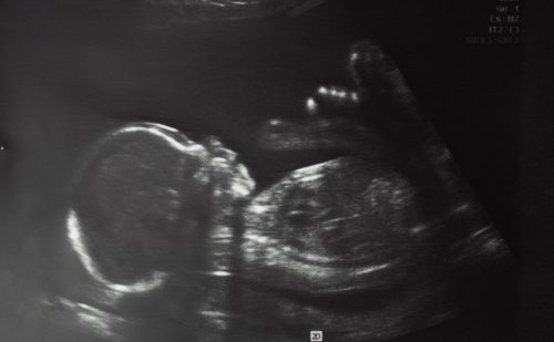 After choosing abortion due to ‘abnormalities,’ they found out their babies were ‘normal’