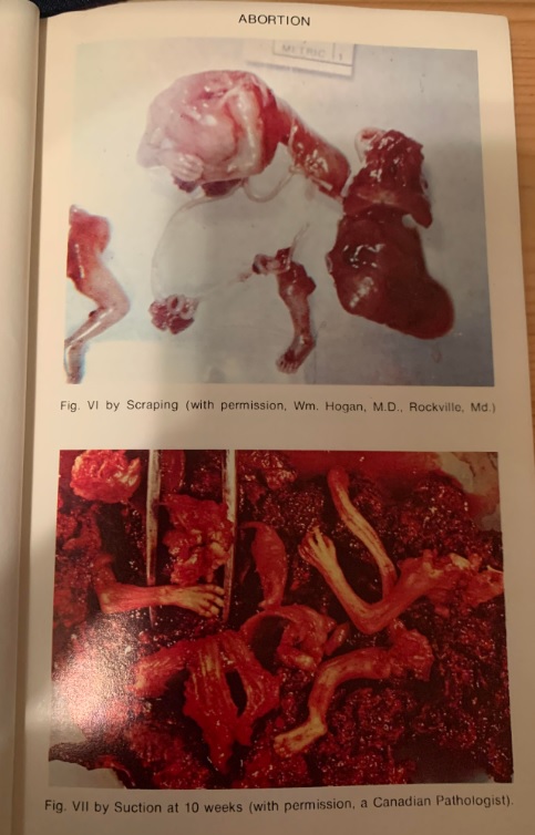 Image: Handbook on Abortion by Mrs. and Dr. Jack C Willke aborted baby first trimester