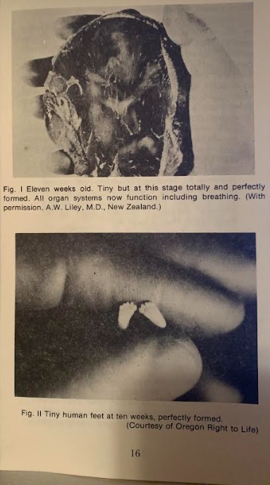 Image: Precious Feet image in Handbook on Abortion Mrs. and Dr. Jack C Willke