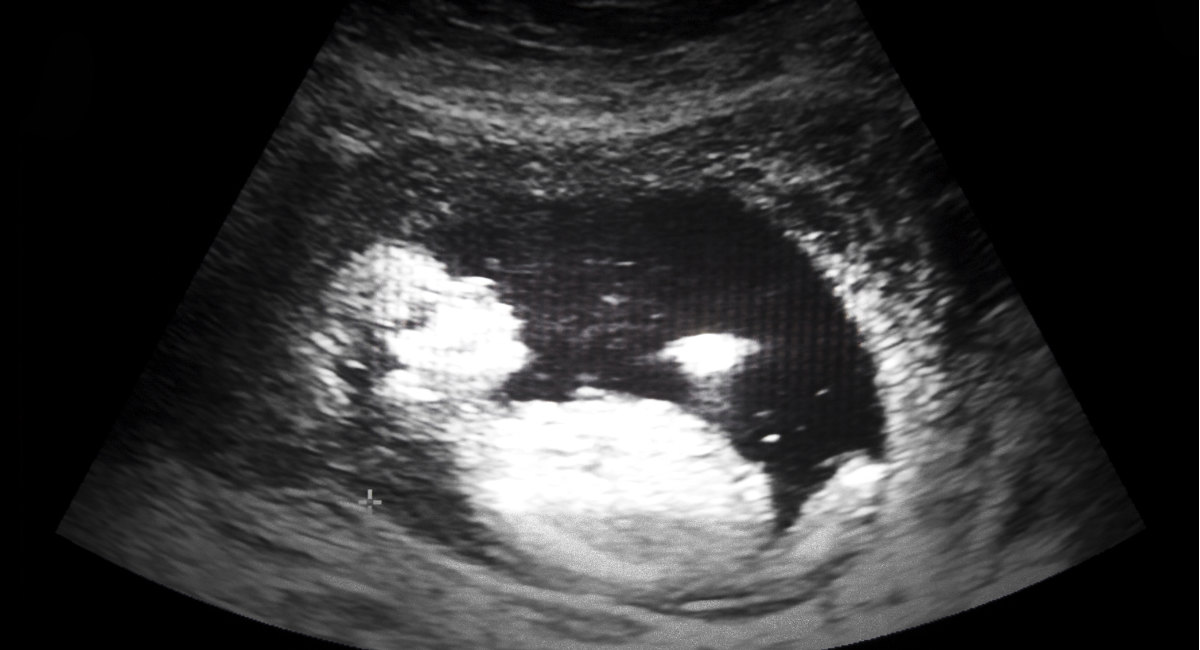 13 weeks gestation (11 weeks post fertilization)